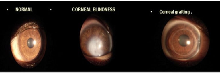 Corneal Blindness Rayhan Eye Hospital And Laser Centre Edappal Kerala Ophthalmology Eye 